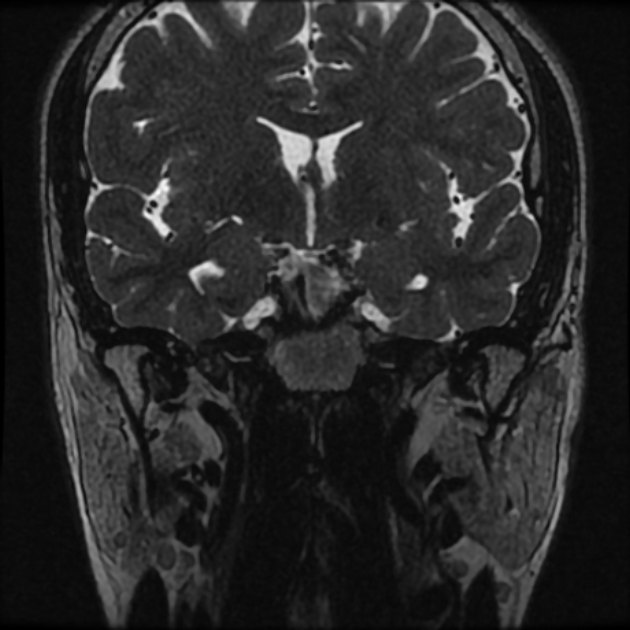 Normal MRI petrous (Radiopaedia 91317-108949 Coronal T2 16).jpg