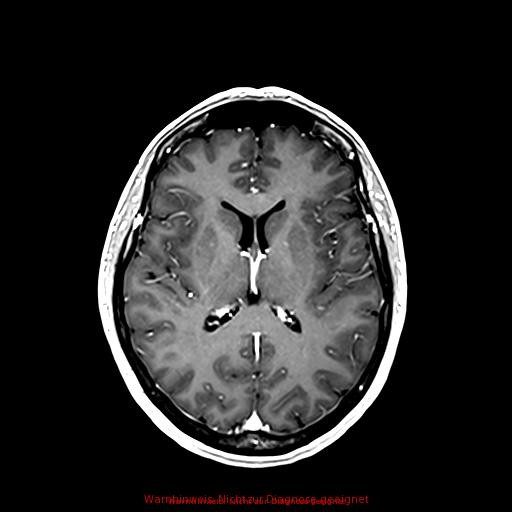 Normal adult brain MRI (non-enhanced and contrast-enhanced) (Radiopaedia 75262-86379 Axial T1 C+ 112).jpg