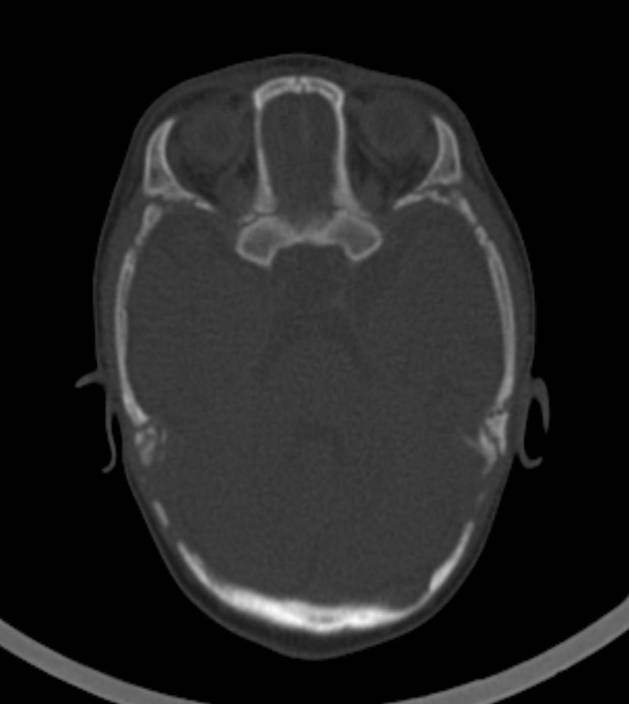Normal brain CT - 2-month-old (Radiopaedia 53369-59350 Axial bone window 43).jpg