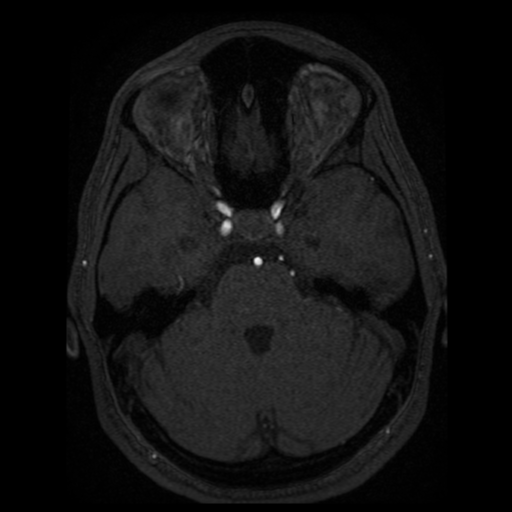 Normal brain MRA (Radiopaedia 41046-43793 Axial MRA 70).png