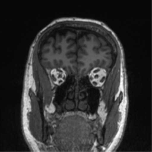 Normal brain MRI (non-focal epilepsy protocol) (Radiopaedia 53917-60040 Coronal T1 53).png