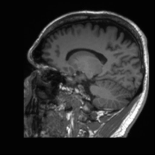Normal brain MRI (non-focal epilepsy protocol) (Radiopaedia 53917-60040 Sagittal T1 25).png