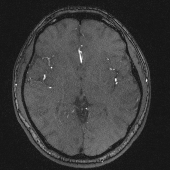 Normal brain MRI including MRA (Radiopaedia 48748-53763 Axial MRA 110).jpg