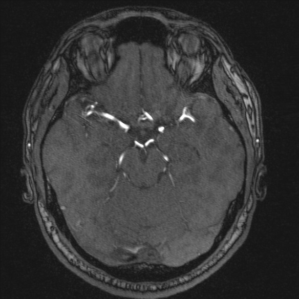 Normal brain MRI including MRA (Radiopaedia 48748-53763 Axial MRA 79).jpg