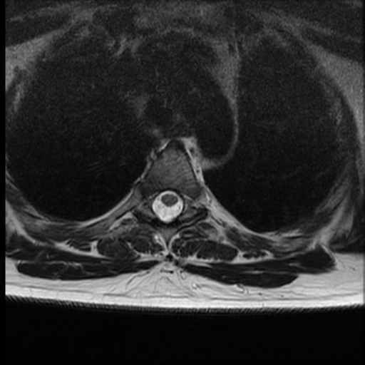 File:Normal cervical and thoracic spine MRI (Radiopaedia 35630-37156 H 33).png