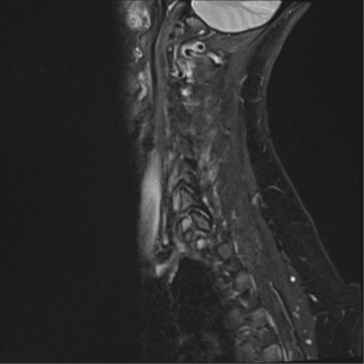 File:Normal cervical spine MRI (including Dixon) (Radiopaedia 42762-45925 Dixon- Water 15).png