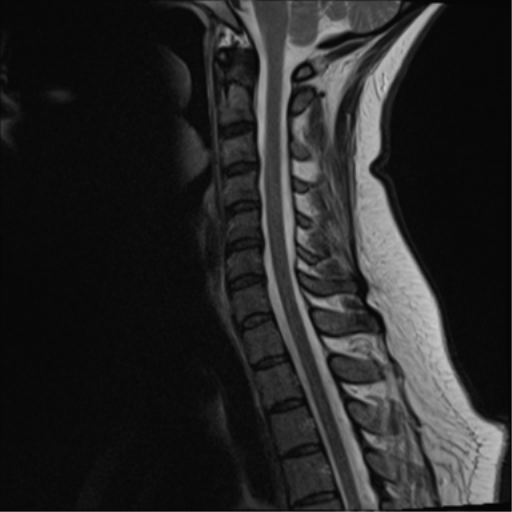 File:Normal cervical spine MRI (including Dixon) (Radiopaedia 42762-45925 Dixon- in-phase 9).png