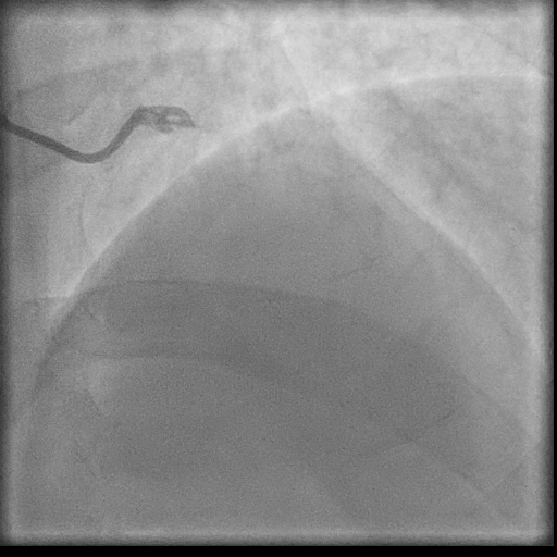 Normal coronary angiogram (DSA) (Radiopaedia 63081-71571 E 14).jpg