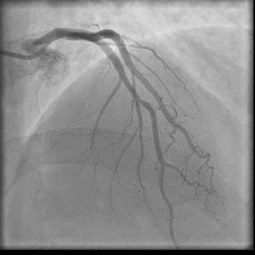 Normal coronary angiogram (DSA) (Radiopaedia 63081-71571 E 42).jpg