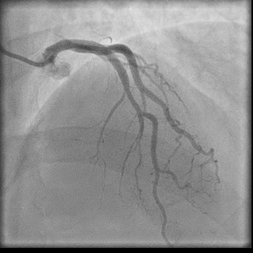 Normal coronary angiogram (DSA) (Radiopaedia 63081-71571 E 48).jpg