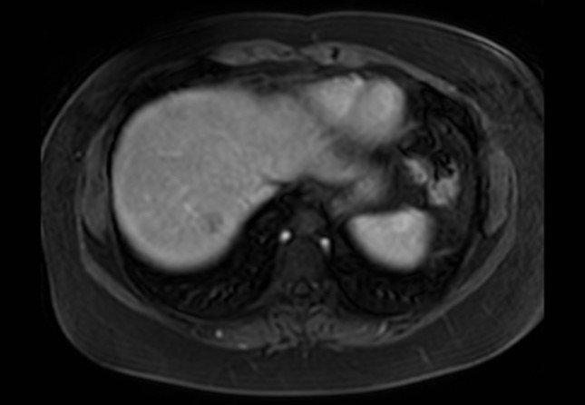 Normal liver MRI with Gadolinium (Radiopaedia 58913-66163 J 66).jpg