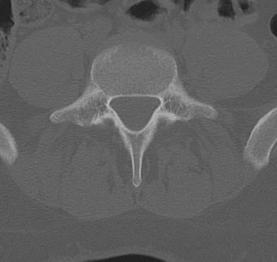 File:Normal lumbar spine CT (Radiopaedia 46533-50986 Axial bone window 57).png