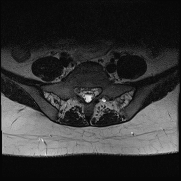 File:Normal lumbar spine MRI- 3 T (Radiopaedia 53280-59250 Axial T2 30).jpg