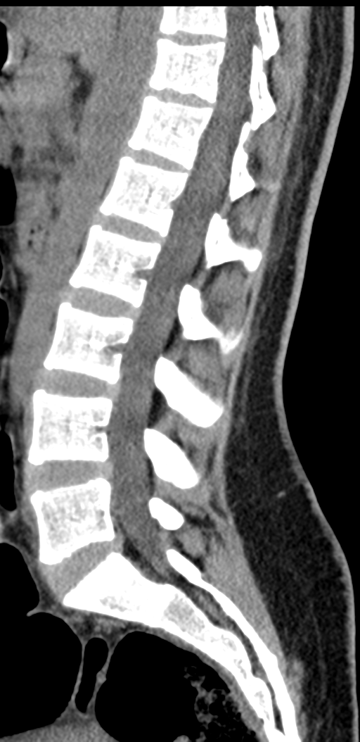 Normal lumbosacral CT (Radiopaedia 37923-39867 E 54).png
