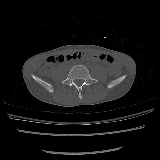 Normal pelvis CT (Radiopaedia 51471-57236 Axial bone window 7).jpg
