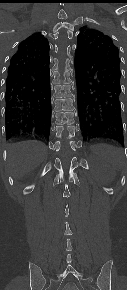 Normal thoracolumbar spine (Radiopaedia 43822-47309 Coronal bone window 66).png