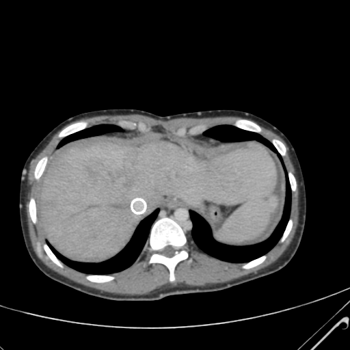 File:Nutmeg liver- Budd-Chiari syndrome (Radiopaedia 46234-50635 B 9).png