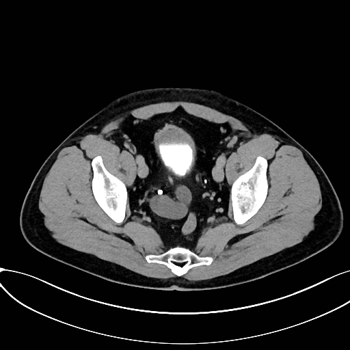 Obstructed upper pole ureter in a duplex kidney (Radiopaedia 54935-61221 Axial C+ delayed 95).jpg