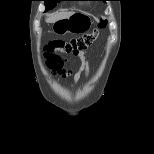 Obstructing renal calculus (Radiopaedia 29517-30016 Coronal non-contrast 8).jpg