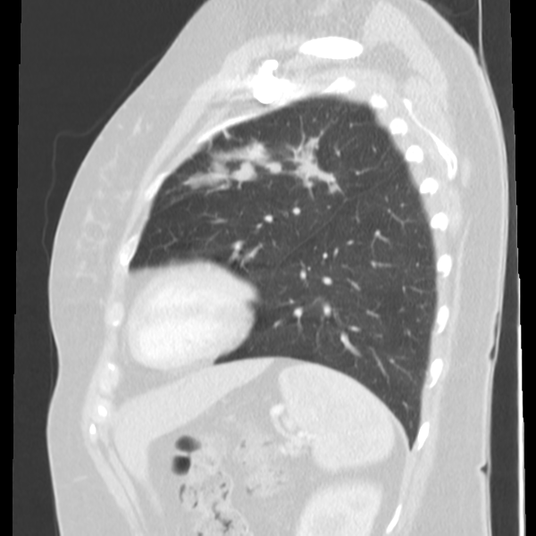 Obstructing typical carcinoid causing bronchoceles (Radiopaedia 50149-55476 Sagittal lung window 44).png