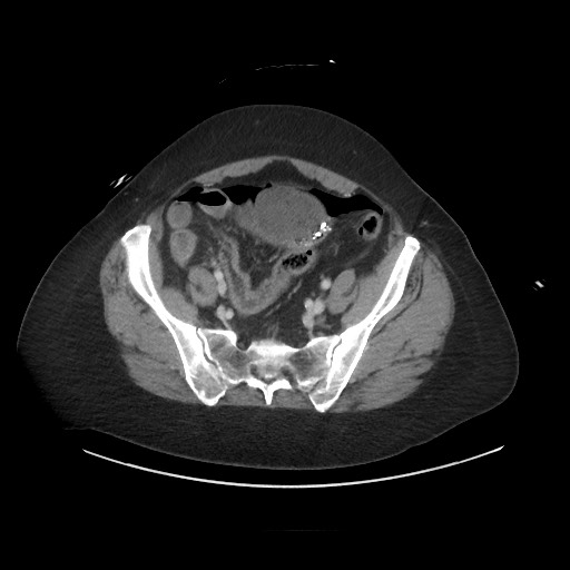 Obstructive distal colonic adenocarcinoma causing cecal perforation (Radiopaedia 86830-102989 A 151).jpg