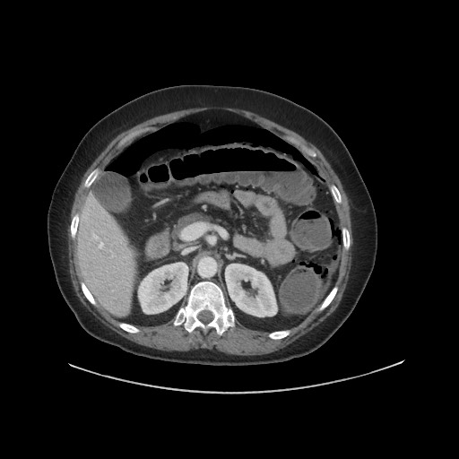 Obstructive distal colonic adenocarcinoma causing cecal perforation (Radiopaedia 86830-102989 A 67).jpg
