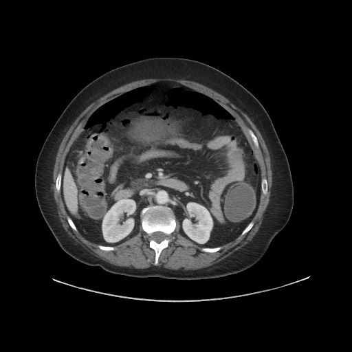 Obstructive distal colonic adenocarcinoma causing cecal perforation (Radiopaedia 86830-102989 A 85).jpg