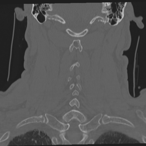 File:Occipital condyle fracture (Radiopaedia 33467-34517 Coronal bone window 47).png