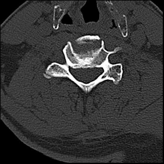 Occipital condyle fracture (type 1) (Radiopaedia 87670-104084 Axial bone window 55).jpg