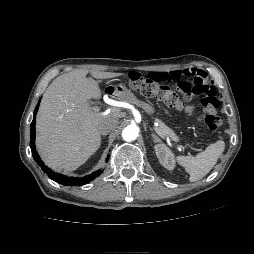 Abdominal aortic aneurysm (Radiopaedia 13341-13340 Axial C+ arterial phase 45).jpg