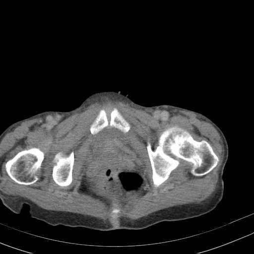 File:Abdominal aortic aneurysm (Radiopaedia 20827-20742 Axial C+ delayed 38).jpg