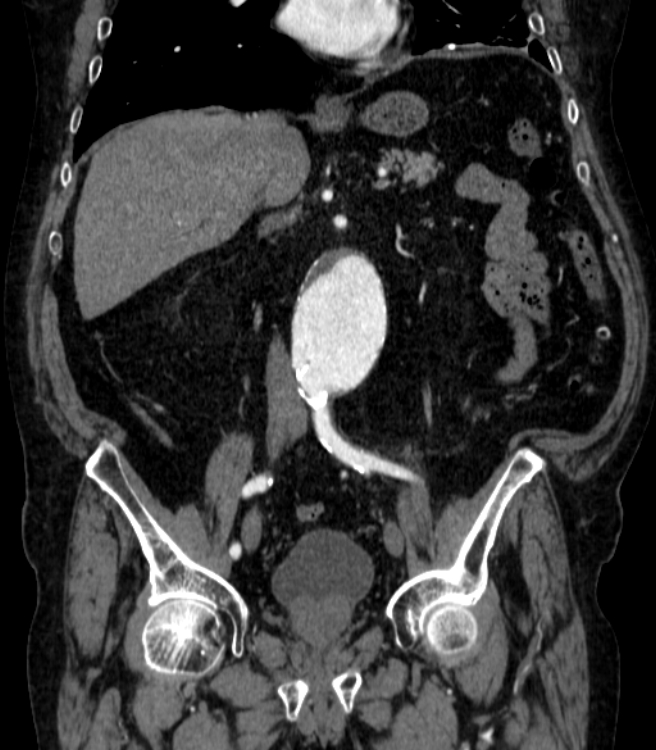 Abdominal aortic aneurysm (Radiopaedia 25855-26001 Coronal C+ arterial phase 30).jpg