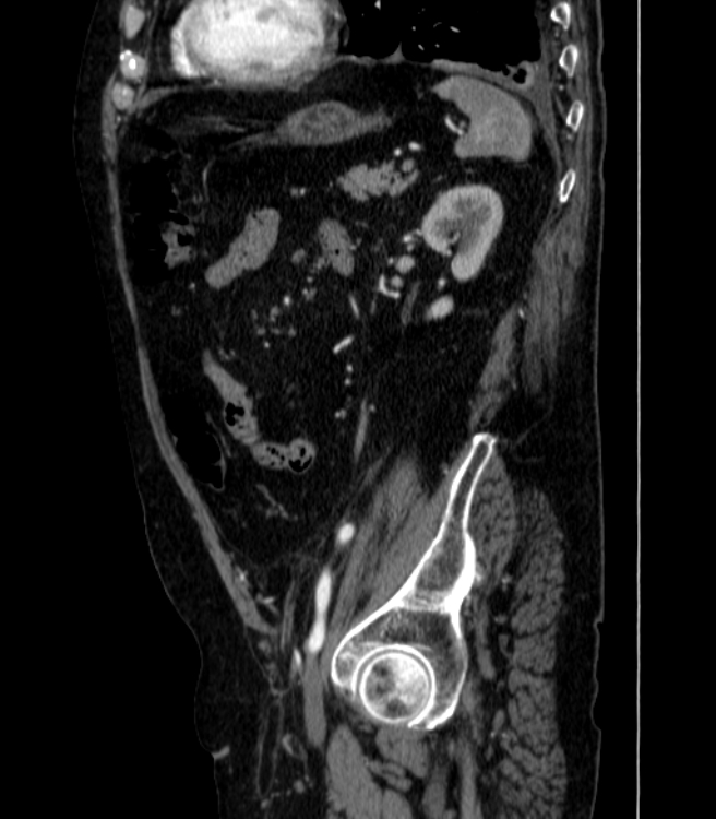 Abdominal aortic aneurysm (Radiopaedia 25855-26001 Sagittal C+ arterial phase 55).jpg