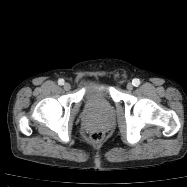 Abdominal aortic aneurysm (Radiopaedia 29248-29660 Axial C+ arterial phase 90).jpg