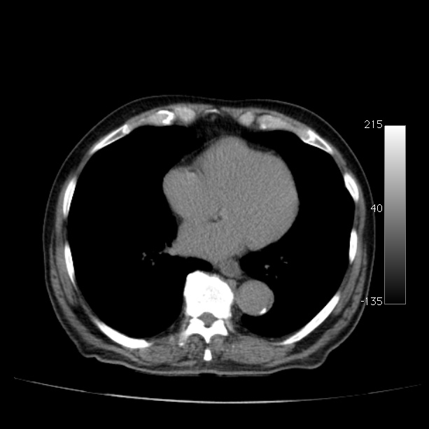 Abdominal aortic aneurysm (Radiopaedia 29248-29660 Axial non-contrast 2).jpg
