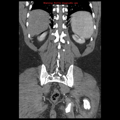 Abdominal aortic aneurysm (Radiopaedia 8190-9038 Coronal C+ arterial phase 104).jpg