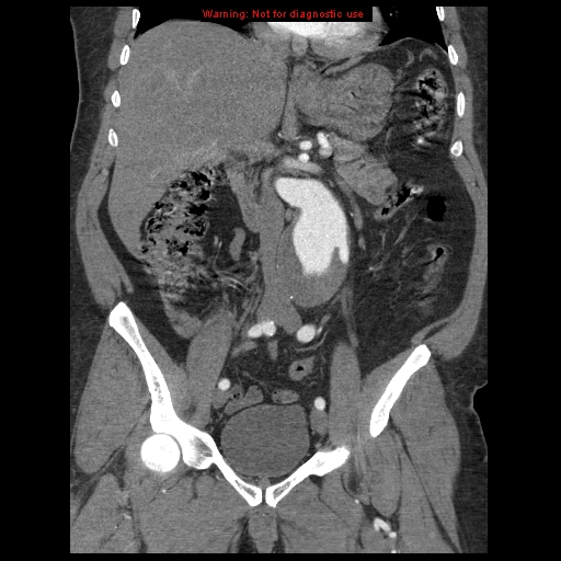 Abdominal aortic aneurysm (Radiopaedia 8190-9038 Coronal C+ arterial phase 61).jpg