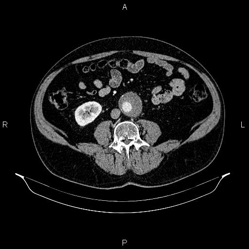 Abdominal aortic aneurysm (Radiopaedia 83094-97462 Axial renal cortical phase 111).jpg