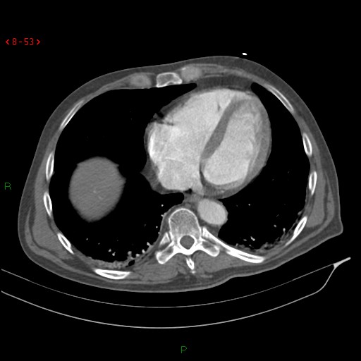 File:Abdominal aortic aneurysm rupture with aortocaval fistula (Radiopaedia 14897-14841 Axial C+ arterial phase 53).jpg