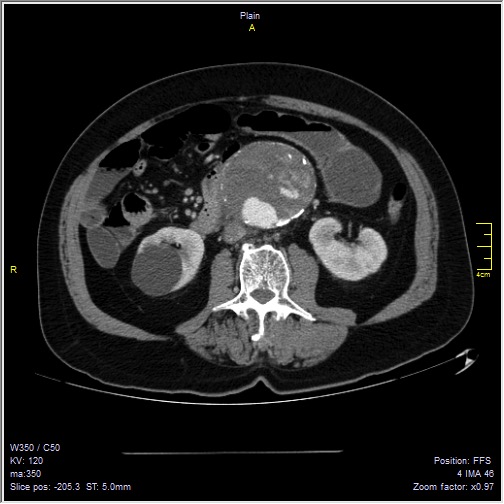 Abdominal aortic aneurysm with thrombus fissuration (Radiopaedia 47340-51926 Axial C+ arterial phase 30).jpg