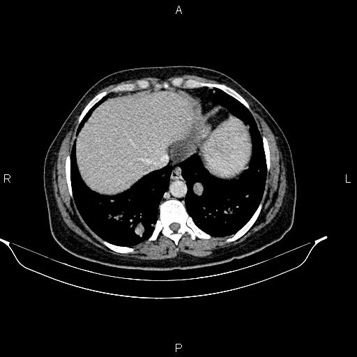 File:Abdominal lymphoma with sandwich sign (Radiopaedia 84378-99704 Axial C+ portal venous phase 7).jpg