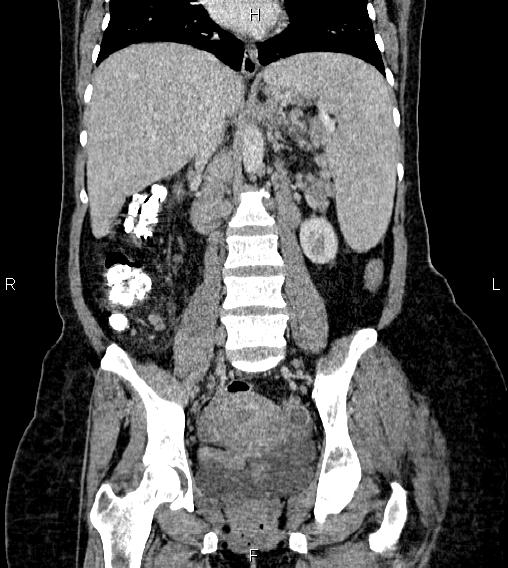 Abdominal lymphoma with sandwich sign (Radiopaedia 84378-99704 Coronal C+ portal venous phase 38).jpg