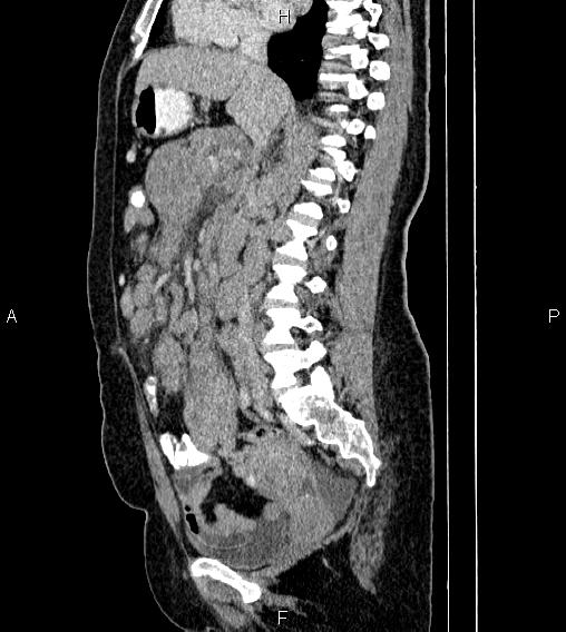 Abdominal lymphoma with sandwich sign (Radiopaedia 84378-99704 Sagittal C+ portal venous phase 40).jpg