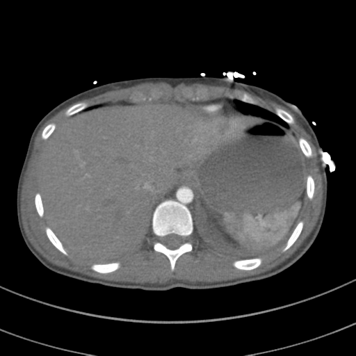 File:Abdominal multi-trauma - devascularised kidney and liver, spleen and pancreatic lacerations (Radiopaedia 34984-36486 Axial C+ arterial phase 76).png