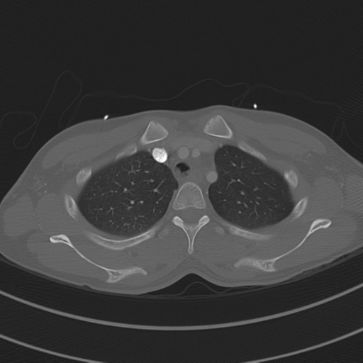 File:Abdominal multi-trauma - devascularised kidney and liver, spleen and pancreatic lacerations (Radiopaedia 34984-36486 I 21).png