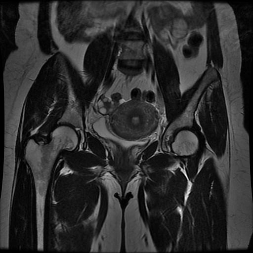 File:Abdominal wall endometriosis (Radiopaedia 83702-98847 Coronal T2 8).jpg