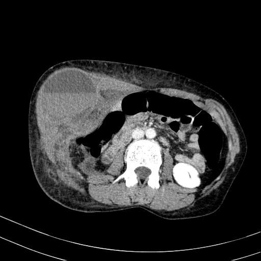 File:Abdominal wall hematoma with active bleeding (Radiopaedia 83915-99117 Axial C+ portal venous phase 40).jpg