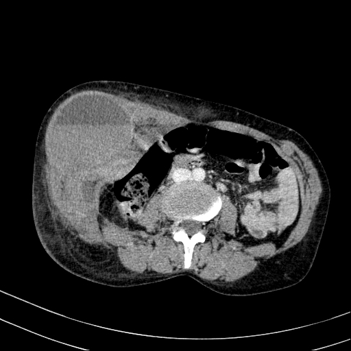 Abdominal wall hematoma with active bleeding (Radiopaedia 83915-99117 Axial C+ portal venous phase 50).jpg