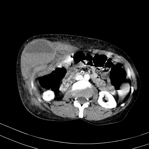 Abdominal wall hematoma with active bleeding (Radiopaedia 83915-99117 Axial renal cortical phase 35).jpg