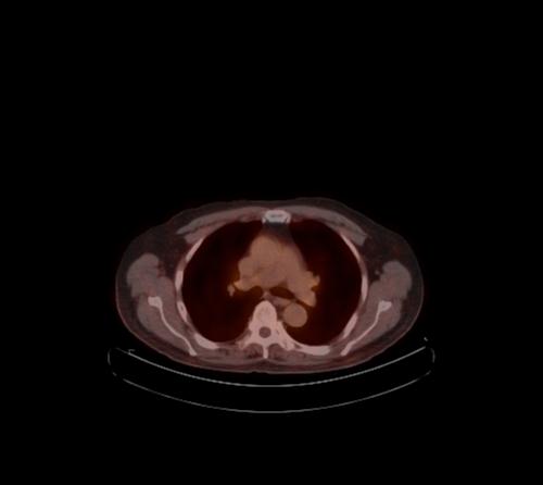 Abdominal wall metastasis from colorectal carcinoma (Radiopaedia 31016-31719 C 112).jpg